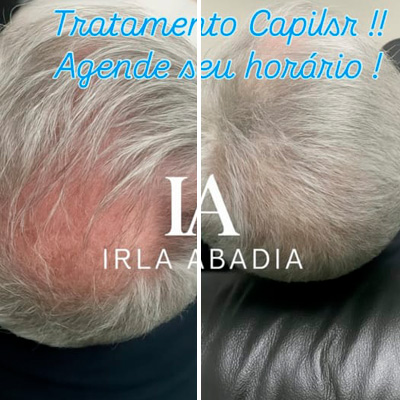 tratamento calvice com ozonioterapia