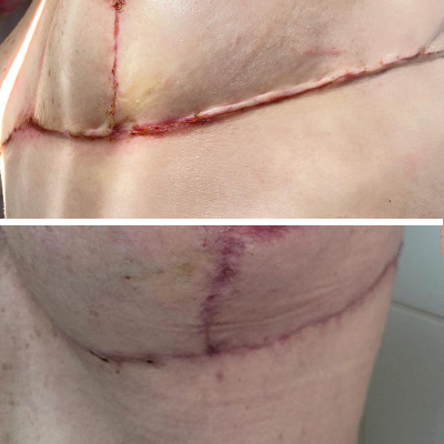 tratamento cicatrizes com ozonioterapia 3