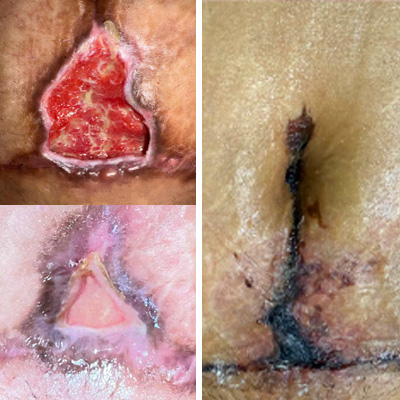 tratamento cicatrizes com ozonioterapia 4