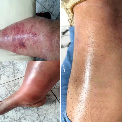 tratamento inchaço e feridas com ozonioterapia