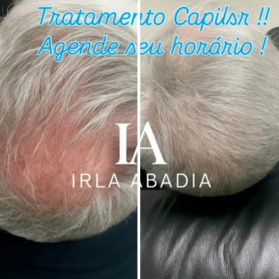 tratamento-calvice-com-ozonioterapia