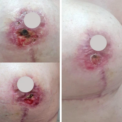 tratamento-cicatrizes-com-ozonioterapia-2